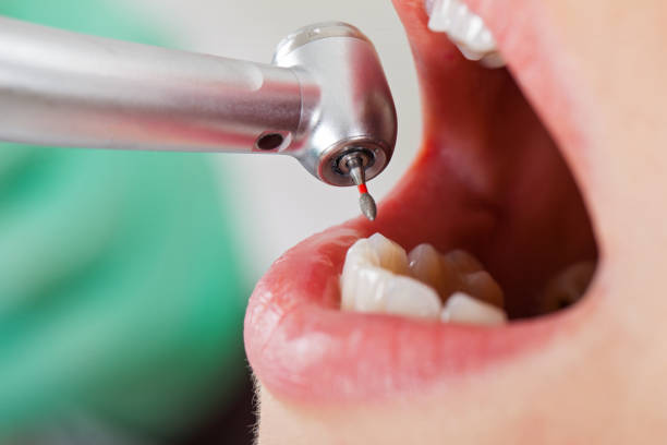 Best Emergency Dental Extractions in Holladay, UT